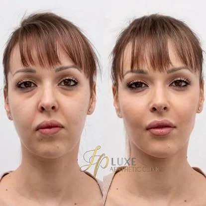Rostro antes de armonización facial en JP Luxe Caguas