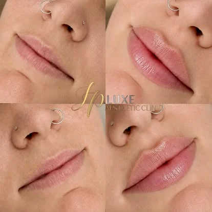 Labios antes del relleno en JP Luxe Caguas
