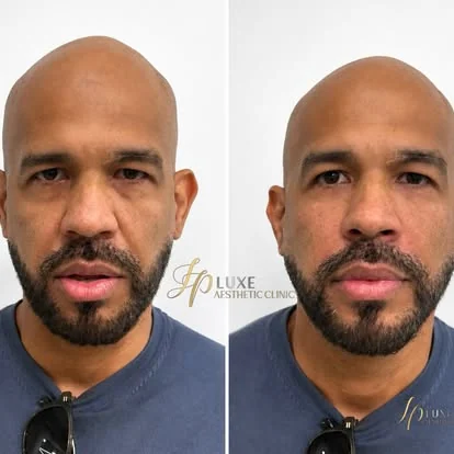 Rostro masculino antes de rejuvenecimiento en JP Luxe Caguas